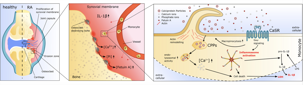 In dem Bild sieht man die schematische Darstellung der rheumatoiden Arthritis, der Freisetzung von Calcium, Phosphat und Fetuin-A aus dem Knochen, und die Signaltransduktion im Monozyten nach Aktivierung durch Calcium.